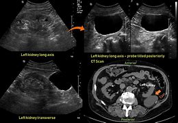 Image result for Large Renal Cyst