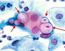 Image result for Chlamydia Trachomatis Discharge Color