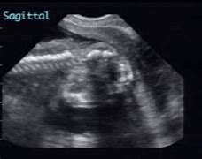 Image result for Anencephaly in Anteatal USG