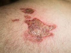 Image result for Burn Scab