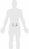 Image result for Advanced Renal Cell Carcinoma