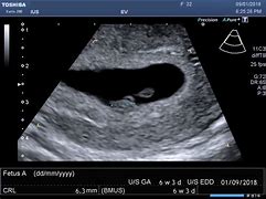 Image result for Baby Ultrasound at 6 Weeks