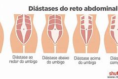 Image result for Diastase Do Reto