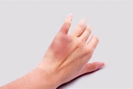 Image result for Bruise Hand Squeeze