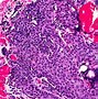 Image result for Inverted Papilloma Causes