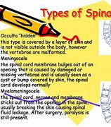 Image result for Types of Spina Bifida