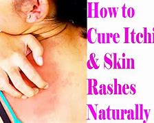 Image result for itch rash treatments