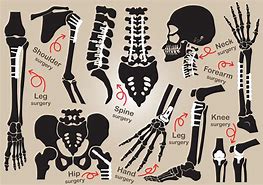 Image result for Orthopedic Surgery Clip Art