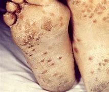 Image result for Syphilis Rash On Foot