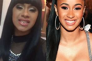 Image result for Cardi B Face Surgery