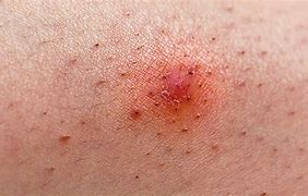 Image result for Ingrown Hair On Finger