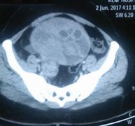 Image result for Ovarian Cyst CT Scan