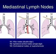 Image result for Mediastinal Lymph Node Staging