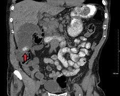 Image result for Gallbladder Mass CT