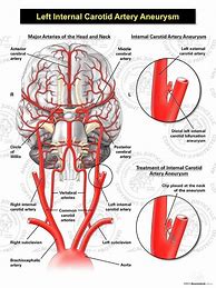 Image result for Path of Internal Carotid Artery