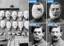 Image result for War Injuries WW1