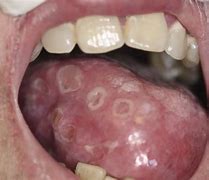 Image result for Tertiary Syphilis