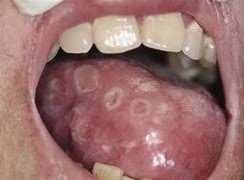 Image result for Syphilis On Gums