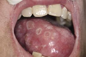Image result for Syphilis in Lips