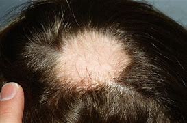Image result for alopecua