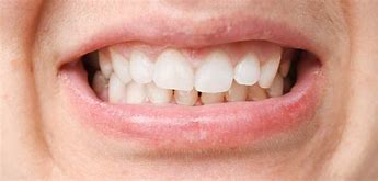 Image result for Jaw Misalignment