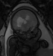 Image result for Meningomyelocele