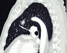 Image result for 12Mm Spiculated Nodule in Left Upper Lobe
