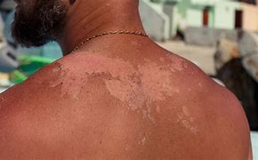 Image result for Blistering Sunburn