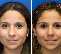 Image result for Bulbous Tip Rhinoplasty