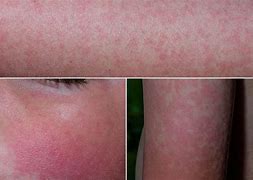Image result for Fifth Disease Child