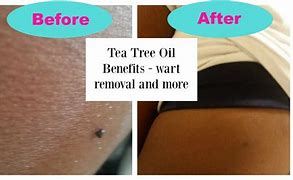 Image result for Tea Tree Oil Wart Removal