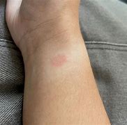 Image result for Apple Watch Burns