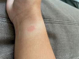Image result for Apple Watch Band Rash
