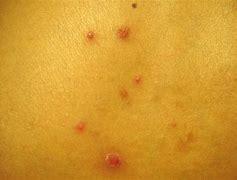 Image result for Folliculitis Staph Infection