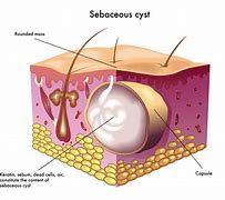 Image result for Types of Cysts On Skin