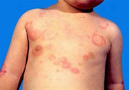Image result for Erythema