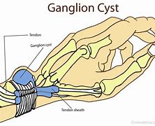 Image result for Ganglion Cyst Tendon