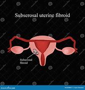Image result for Subserous Fibroids