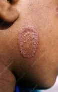 Image result for Fungus On Human Skin