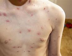 Image result for Chickenpox Disease