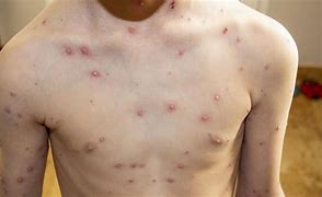 Image result for Chickenpox Blisters