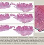 Image result for Verrucous Hyperplasia Tongue