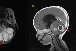 Image result for Occipital Cyst