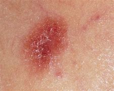 Image result for Pink Mole Skin Cancer