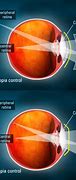 Image result for Myopia Spots and Floaters