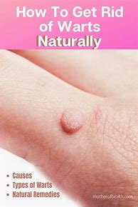 Image result for How to Get Rid of Warts On Ankle Naturally