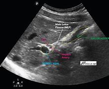 Image result for Abdominal Ultrasound Images Abdomen
