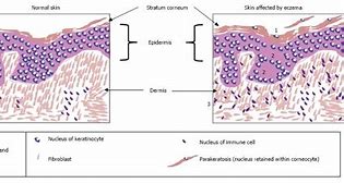 Image result for Eczema Skin Flake Under Microscope