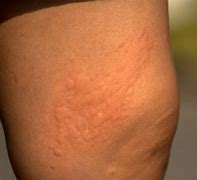 Image result for Warts Thigh