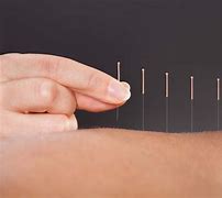 Image result for What Is Acupuncture